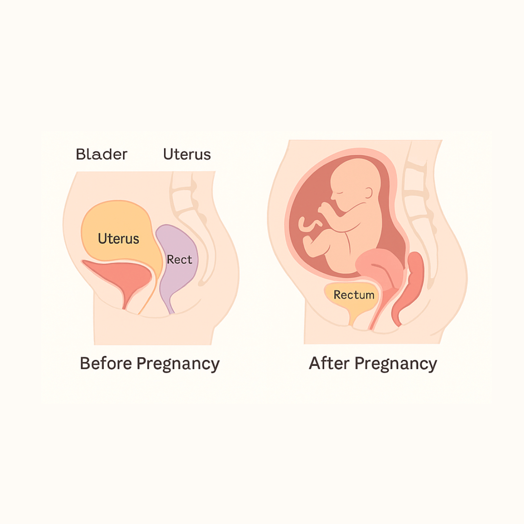Infographic comparing pelvic floor muscles before pregnancy and after birth, showing stretching and organ pressure changes.